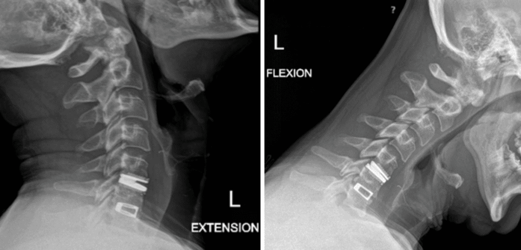 Postoperative dynamic xrays; note the differences in range of motions between the artificial disc at C5-6 and the previous fusion at C6-7