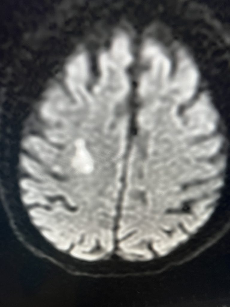 Pre-operative imaging shows multiple areas of most likely embolic stroke in the right corona radiata
